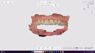 Complete Lower Denture over Implants IOS [upl. by Animaj114]