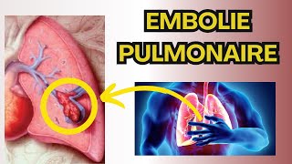 L Embolie Pulmonaire  Diagnostic  Traitement [upl. by Antonie574]