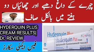 Hyderquin plus cream uses Melasma Hyperpigmentation freckle and acne scar treatment formula cream [upl. by Lapo]