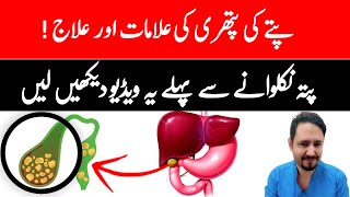 Gallbladder Stones  Bile Salt In Urdu Hindi  Dr Irfan [upl. by Anilah]