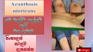 Acanthosis nigricansසමමත පැල්ලම් ආශ්‍රිත රෝගcauseshow it happenstreatmentsinhalahow to prevent [upl. by Rois643]