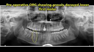 Extraction of grossly decayed lower first molar [upl. by Erreid838]