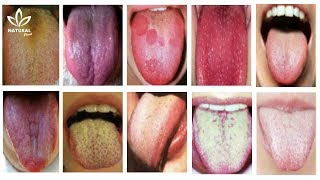 What Your Tongue Has to Say About Your Health [upl. by Trimble]