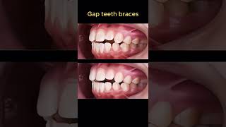 26 month braces braces orthodontist dentist dentistry dental [upl. by Sidonnie]