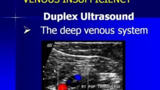 Lower Extremity Venous Duplex Ultrasound Chronic Venous Insufficiency [upl. by Murvyn]