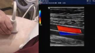 How To Lower Extremity Arterial Duplex Exam [upl. by Delisle]