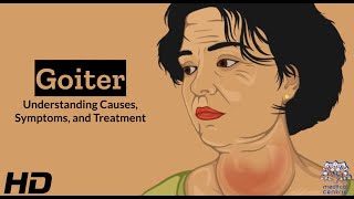 Thyroid Troubles Navigating Goiter  Causes Symptoms and Treatment Explained [upl. by Notlim]