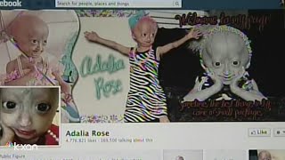 Adalia Rose Austinite social media star with rare genetic condition dies at 15 [upl. by Aehtla]