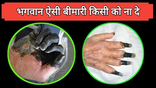 एक एसी खतरनाक बीमारी  Gangrene Symptoms and causes  gangrene kyu hota hai  Dr tarun [upl. by Llehsyar467]