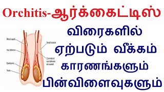 Orchitisஆர்க்கைட்டிஸ் விரைகளில் ஏற்படும் வீக்கம் காரணங்களும் பின்விளைவுகளும் [upl. by Bennett]