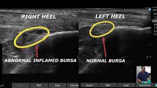 RETRO CALCANEAL BURSITIS PRP PLATELET RICH PLASMA THERAPY REGENERATIVE THERAPY [upl. by Inwat]