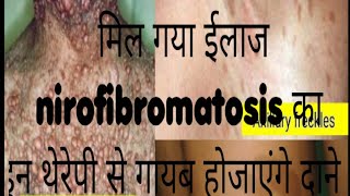 neurofibromatosiscausessign and symptoms diagnosis and treatment [upl. by Ttik]