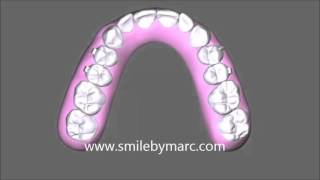 Simulation of orthodontic tooth movement [upl. by Edniya]