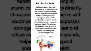 Cochlear Implants [upl. by Liva]