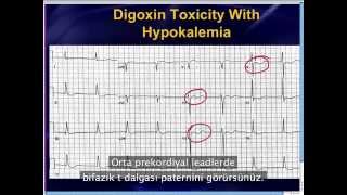 Mattu EKG Vakası Wellens ve Ters Wellens ayrımı  13 Mayıs 13 Türkçe Altyazılı  AcilciNet [upl. by Vallie]