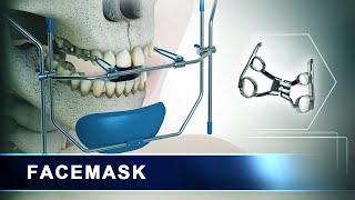 Facemask  Orthodontic Headgear Appliance  3d Animation [upl. by Kinnard]