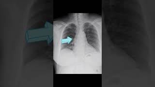 Fusiform aneurysmal dilatation of ascending aorta [upl. by Gnot]