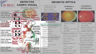 7 DEFECTOS CAMPO VISUAL Y NEURITIS OPTICA [upl. by Barnabe]