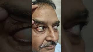 conjunctival cyst conjunctiva eyeball kripanandkumar neet ophthalmology [upl. by Giffy341]