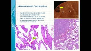 NÓDULOS Y TUMORES HEPÁTICOS [upl. by Ocsic]