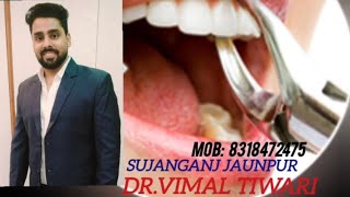 LVN Dental clinic 🦷 🦷 😊Dr vimal tiwari sujanganj jaunpur Tooth Extraction doctor [upl. by Mcnully296]