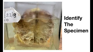 Pathology Specimen Poly Cystic Kidney [upl. by Acinomed]