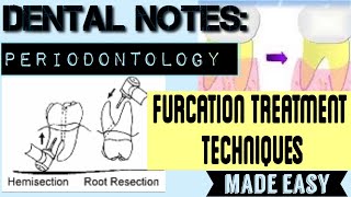 FURCATION INVOLVEMENT PART2 II DENTAL NOTES II PERIODONTOLOGY II TREATMENT PROCEDURES MADE EASY [upl. by Lorens]