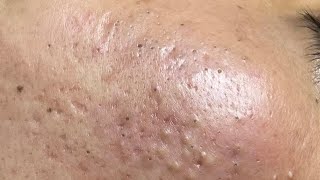 ACNE TREATMENT VU QUYNH MI  Blackheads Perennial EveryWhere Squeeze Chin [upl. by Nohsal]