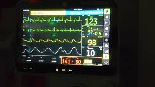 Ventricular Bigeminy [upl. by Schapira508]