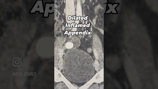 appendicitis computedtomography abdomen acute radiology [upl. by Eeresed]