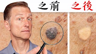 【皮膚】一天快速消除瘜肉和肉疣自然療法柏格醫生 Dr Berg [upl. by Calista909]