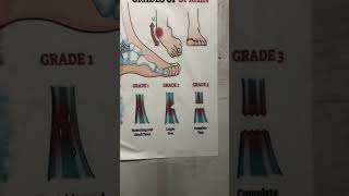 Grading of Ligament Tear youtube [upl. by Eleph379]