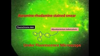 Auramine phenol stain Mycobacterium positveFluorescence microscope [upl. by Hgeilyak]