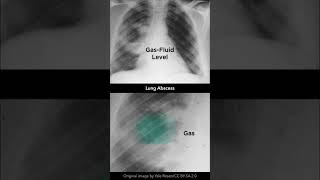 Lung Abscess Chest Xray shorts [upl. by Yebba]