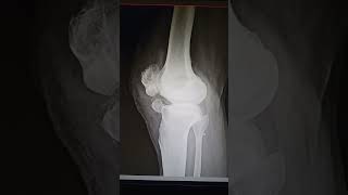 knee joint patella bone fracture youtuber facts doctor youtubeshort [upl. by Halian]