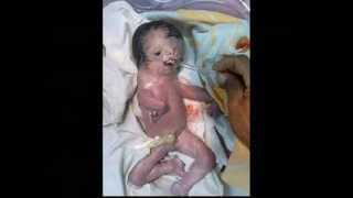 Part 1 Hesham Tillawi Depleted Uranium in Iraq Ten years after the War still causes deformed births [upl. by Mclaurin]