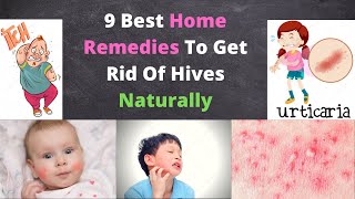 How to Cure Hives Naturally  9 Best Home Remedies [upl. by Romine603]