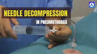 Needle Decompression Procedure in Pneumothorax [upl. by Jolene]