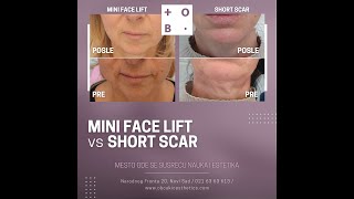 OB Čukić Esthetics  Dr Tamara Petrović – Mini Facelift vs Short Scar Facelift [upl. by Finbur]