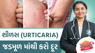 Ayurvedic Treatment Of Urticaria  Dr Devangi Jogal  JOGI Ayurved [upl. by Eiralam]