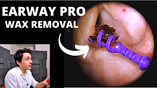 EARWAY PRO Ear Wax Extraction [upl. by Gannie699]