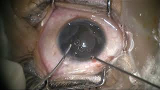 Triple treatment therapy for congenital stromal iris cyst [upl. by Kesley]