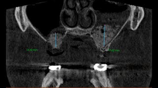 Sinus Lift Augmenation  Lateral Wall Approach  A Debrief [upl. by Nosnek191]