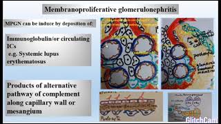 Membranoproliferative glomerulonephritis [upl. by Grof]