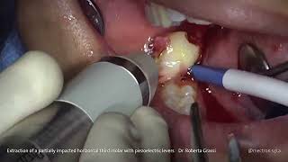 PIEZOSURGERY®  Dr Roberta Grassi Extraction of Impacted Third Molar with Piezo Levers [upl. by Arza]