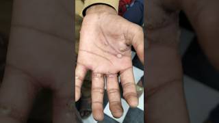 Example of scabies  Sarcoptes scabiei scabies scabiestreatment scabiespadakucing medical viral [upl. by Nylloh]