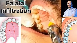 Local Anesthesia Palatal Infiltration Technique Maxillary Anesthesia Techniques dentistry [upl. by Nancy]