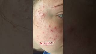 Acne skin problem solution💗acne skin treatment healthy nail pink lips✅ acneclinic acnetreat [upl. by Coveney699]