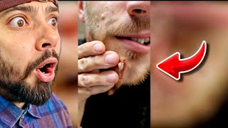 Popping huge blackheads and Giant Pimples Best Pimple Popping Videos [upl. by Ahsimek]