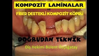 Kompozit Laminalar ve Özçağatay Teknik ile Fiber Destekli Kompozit Köprü Yapımı [upl. by Itak516]